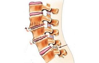 spondylarthosis, mint a hátfájás okai