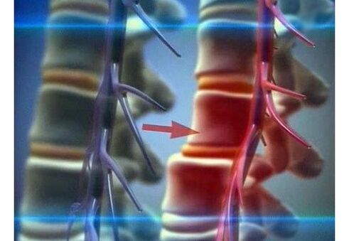 Az idegvégződések összenyomása az ágyéki osteochondrosisban