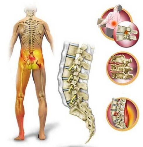 Az ágyéki gerinc osteochondrosisa, amely alsó hátfájást okoz