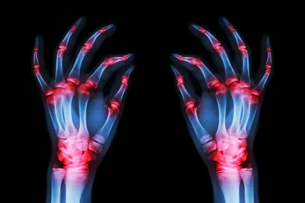 az ujjízületek arthrosisa