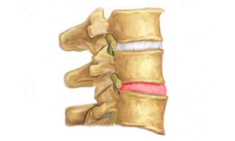A gerinc csigolyaközi lemezének kiemelkedése - az osteochondrosis jele
