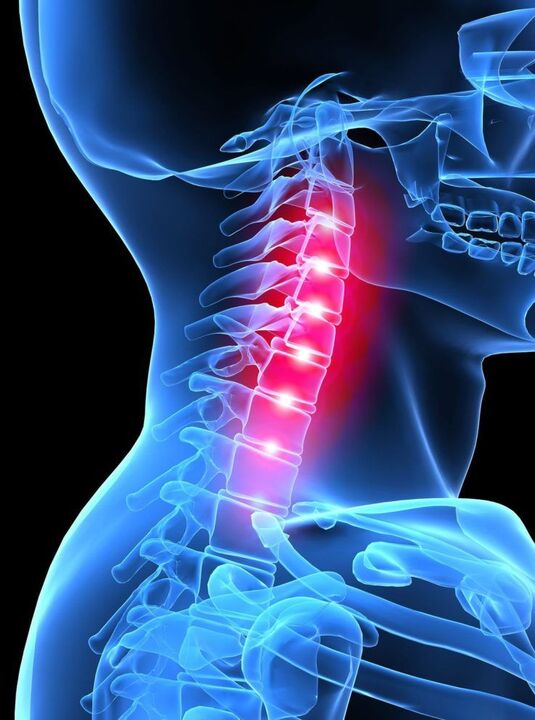 A nyaki gerinc osteochondrosisa