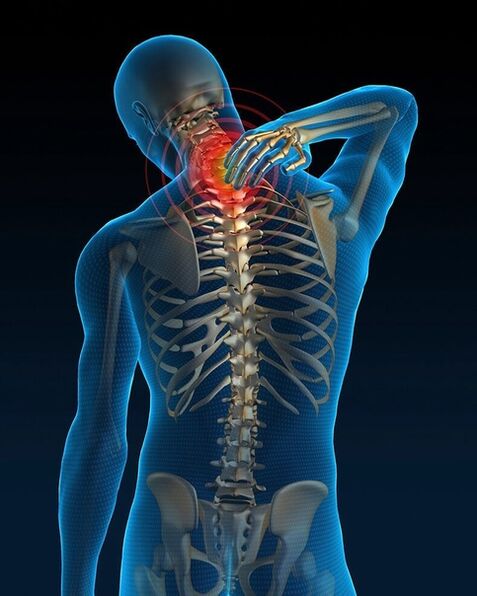 A nyaki osteochondrosis kezelésének kezdeti szakaszában a nyaki fájdalom fokozódik