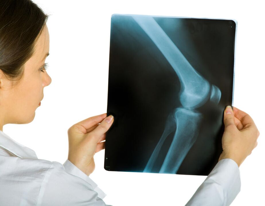 A térdízület röntgenfelvétele megmutatja a deformáló arthrosis jelenlétét